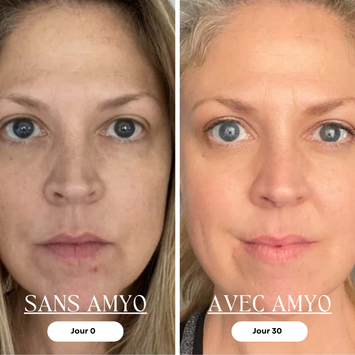 AMYO Masque LED Anti-Âge Lumière Rouge